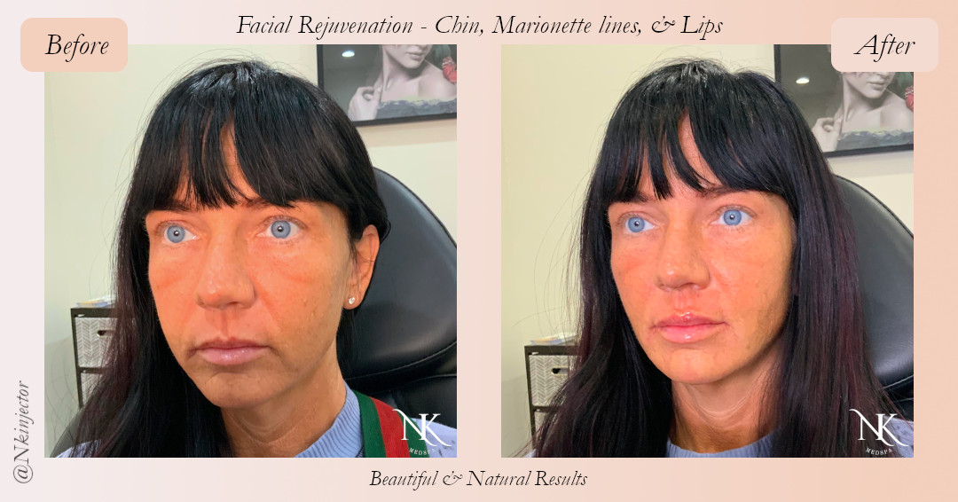 Before & After Chin Marionette Lines Lips Botox Fillers Picture