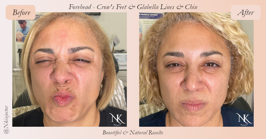 Before & After Crow's Feet Glabella Lines Chin Botox Picture