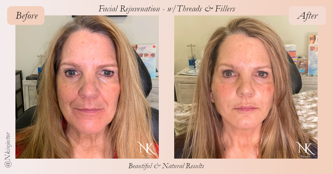 Before & After Fillers Threads Picture 1