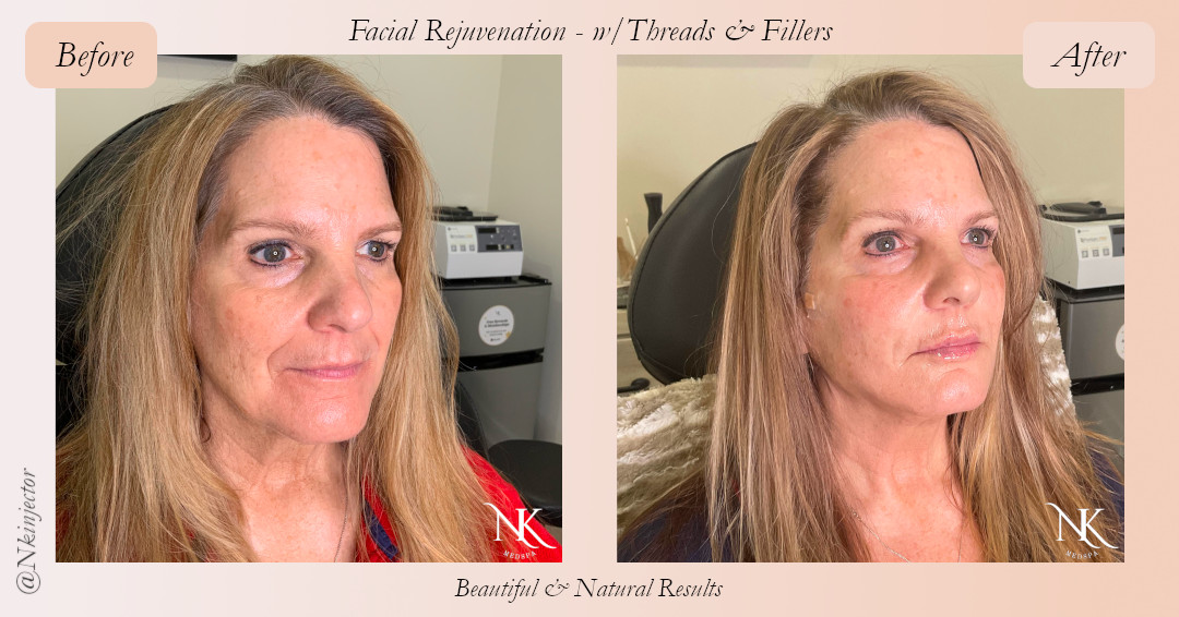 Before & After Fillers Threads Picture