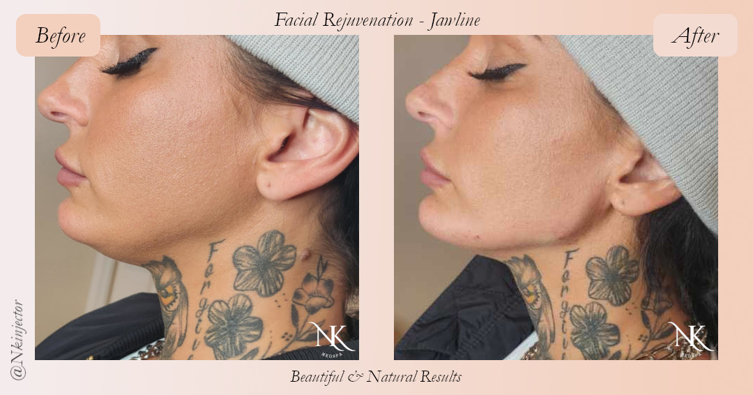 Before & After Jawline Fillers Picture