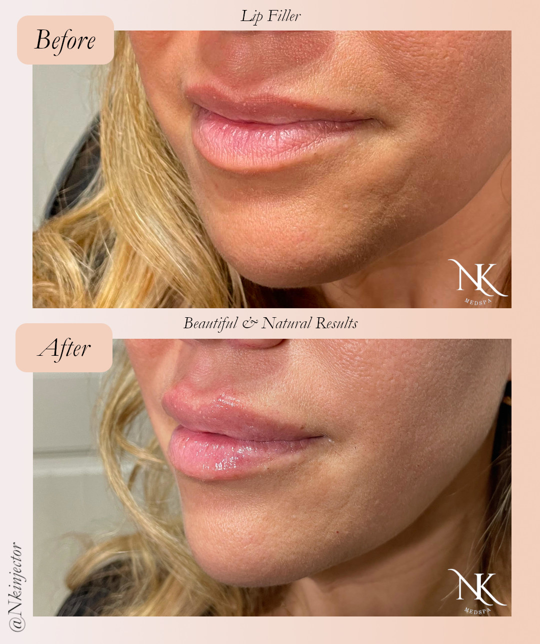 Before & After Lip Fillers Picture 13