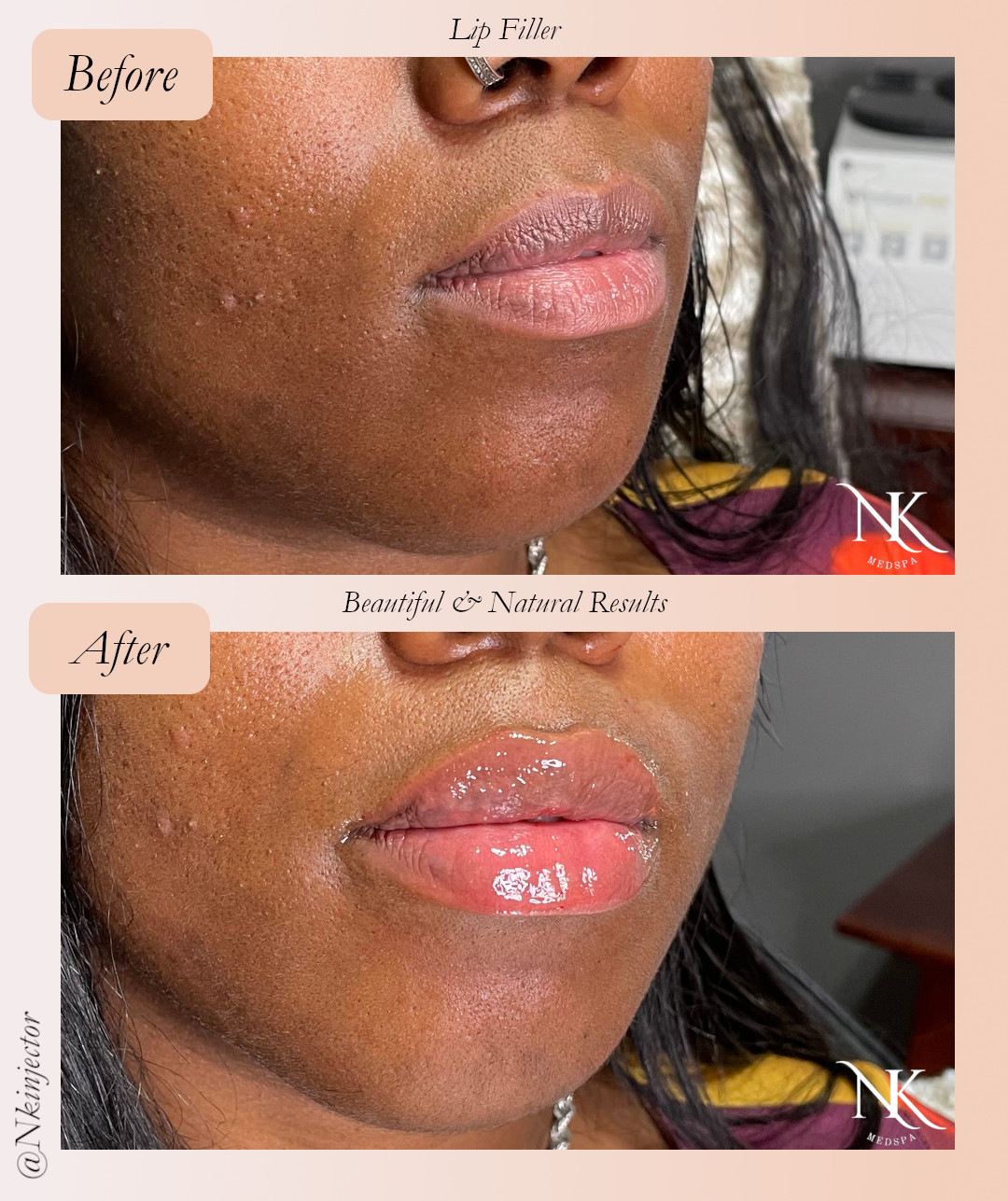 Before & After Lip Fillers Picture 3