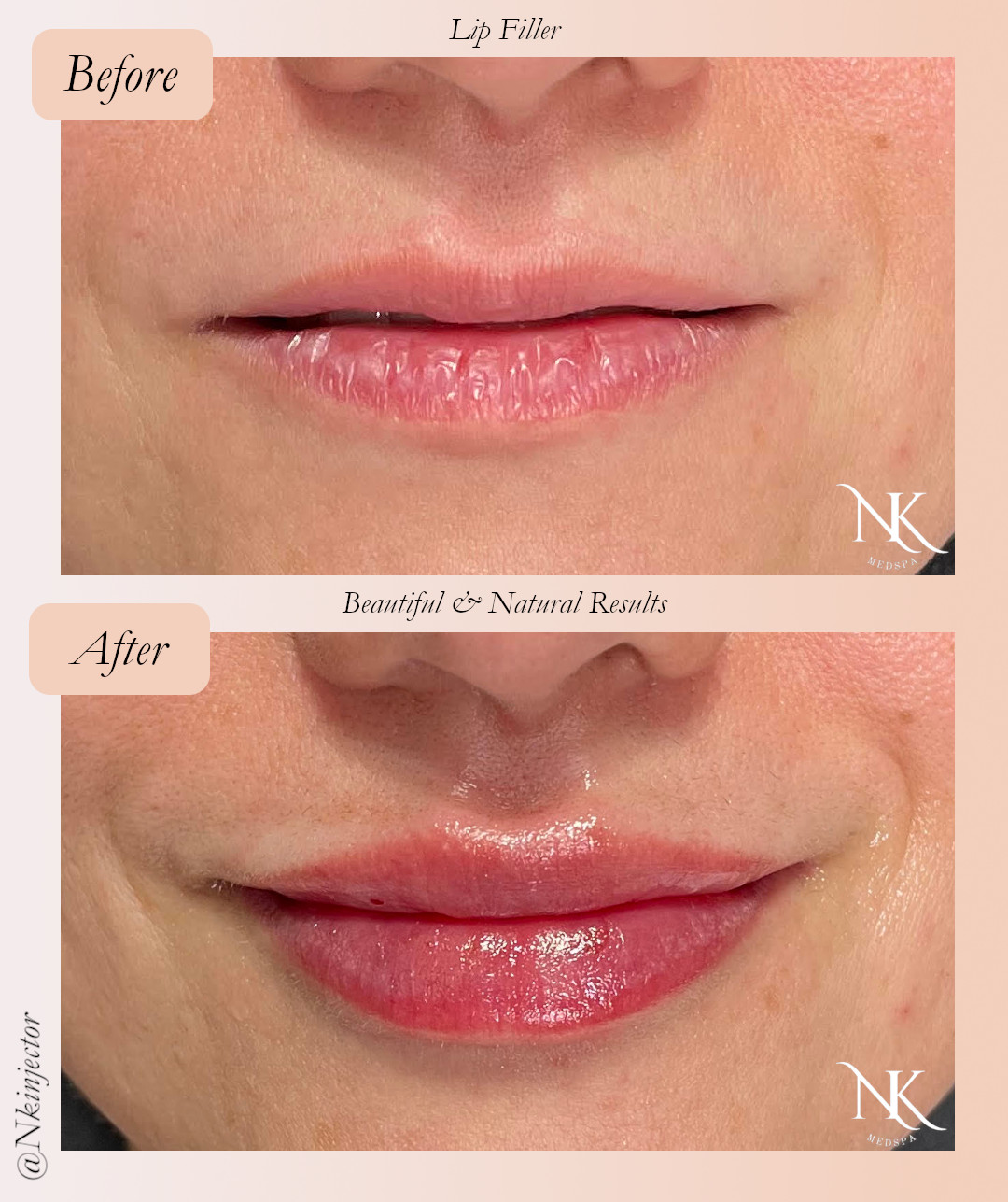 Before & After Lip Fillers Picture